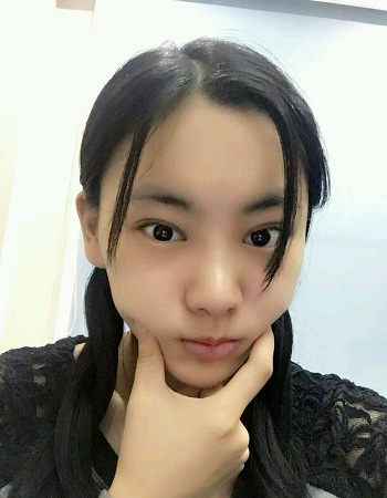 鄭州美萊<a href='/' target='_blank'><u>整形醫院</u></a>案例劉雨婷