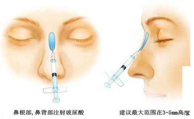 廣州哪個機構隆鼻比較好呢