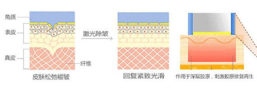 深圳做激光除皺對皮膚能造成傷害嗎