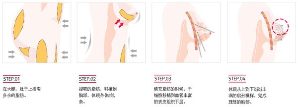 廣州做自體脂肪隆胸術后會不會出現(xiàn)胸部下垂的現(xiàn)象呢