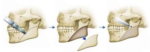 下頜角整形