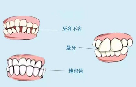 上海做牙齒畸形矯正多少錢