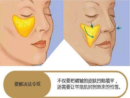 脂肪填充法令紋能維持多少時(shí)間？