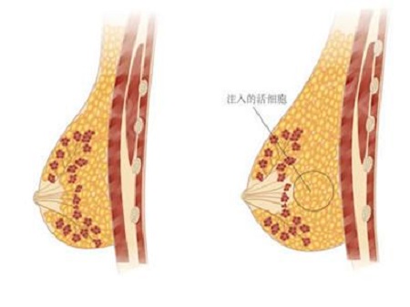 做自體脂肪豐胸手術