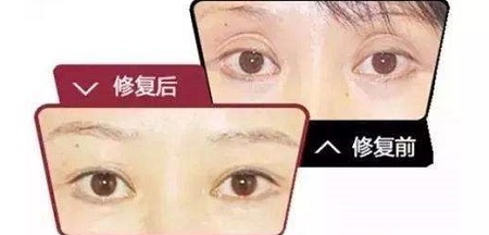 雙眼皮修復應該什么時候修復