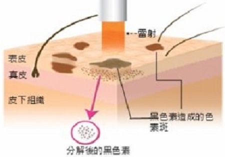 激光祛雀斑價格是多少呢