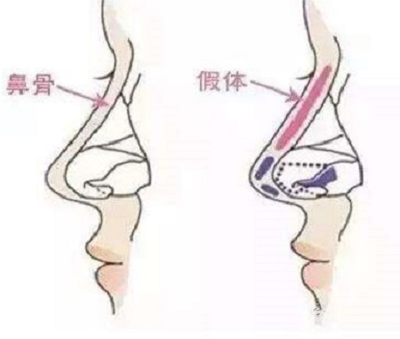 做假體隆鼻手術(shù)以后鼻子