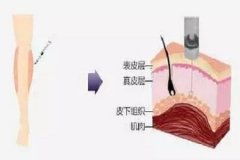 重慶做大腿抽脂手術(shù)后護(hù)理措施有哪些