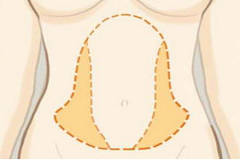 上海做腹部吸脂術后要注意哪些呢