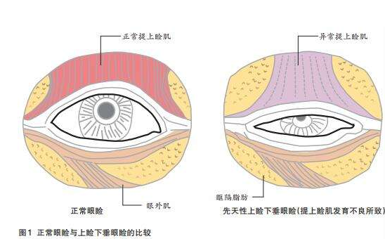 上臉下垂矯正