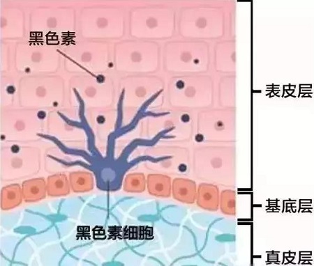 雀斑