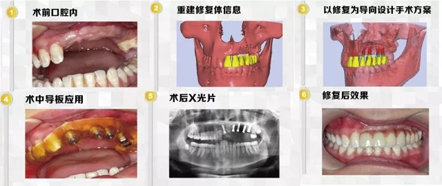 美萊數字化微創種植