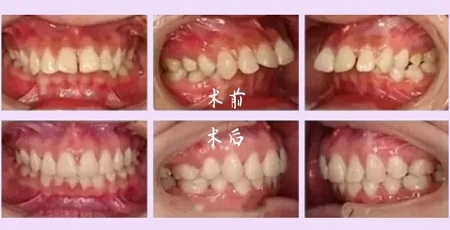 牙齒矯正