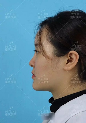 “鼻綜合”后假又歪，還攣縮？鼻修復(fù)還原自然生態(tài)美鼻