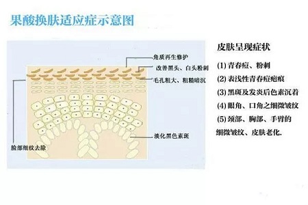 擠痘竟然被送進ICU！你的痘痘還好嗎？