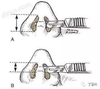 隆鼻手術切口在哪里？才能自然不留疤