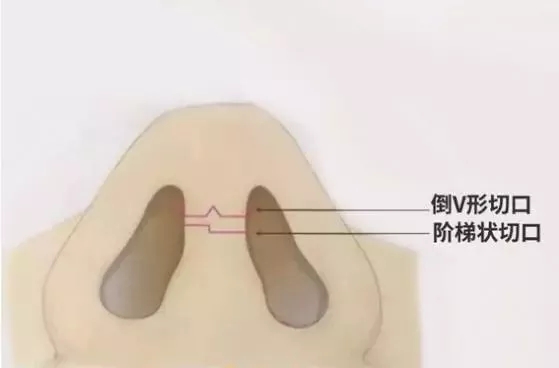 隆鼻手術切口在哪里？才能自然不留疤