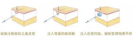 法令紋、川字紋