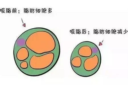 關于吸脂那些不能說的秘密，今天要在這里一次說完！