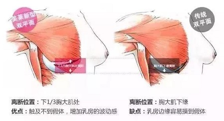 乳房整形