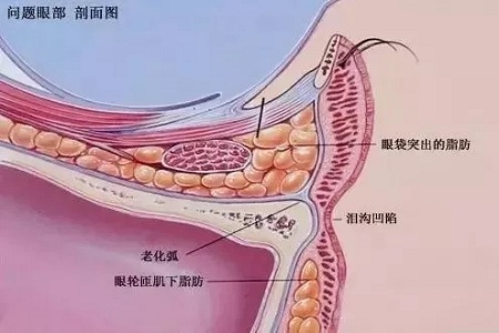 顯老淚溝，你還要任其放肆嗎？