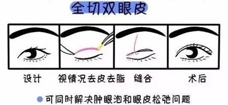 美眼張誠坐診美萊，淺談為什么你的眼睛不夠美？