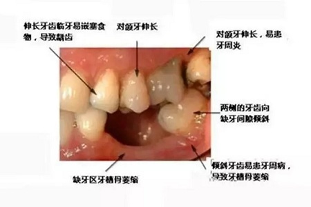 牙齒缺失時，選烤瓷牙還是那種？