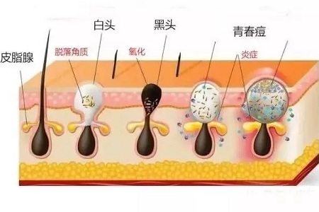 毛孔肌膚粗大怎么解決