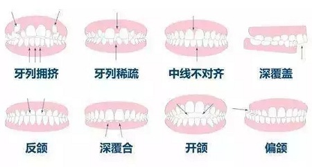 隱形矯正適合的人群