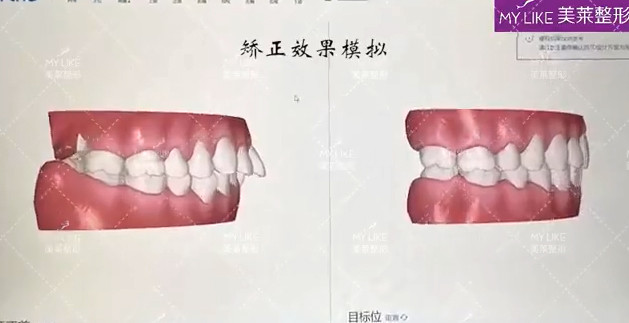 天津美萊口腔·專業(yè)口掃 預(yù)見矯正效果