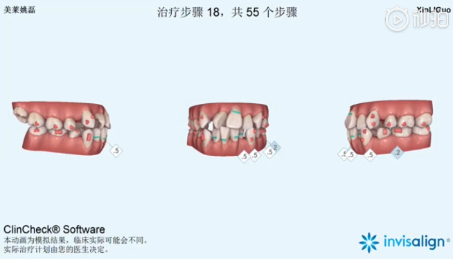 南京美萊口腔全景側(cè)位片，拍照取模，動(dòng)畫方案設(shè)計(jì)