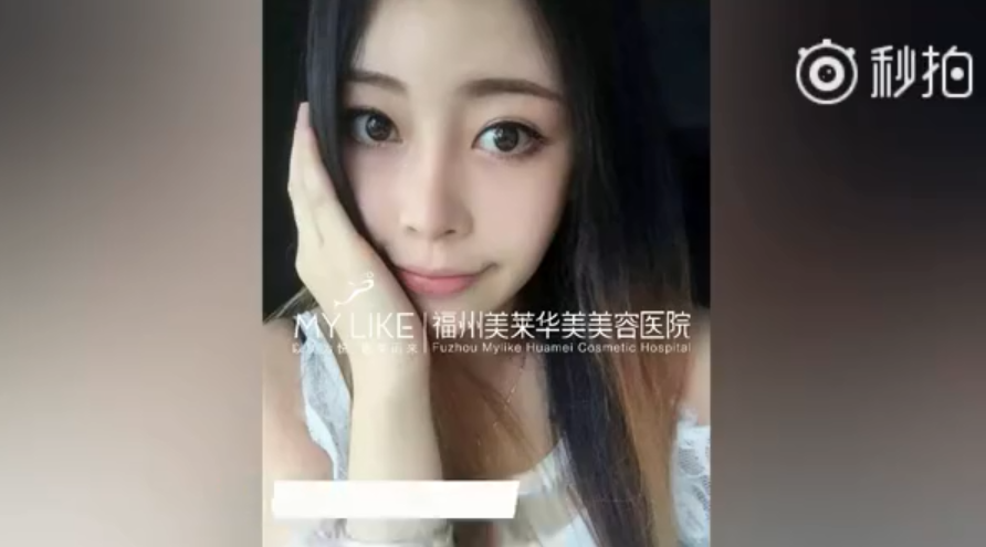 福州美萊鼻子幾毫米的改變，自信百倍的蛻變