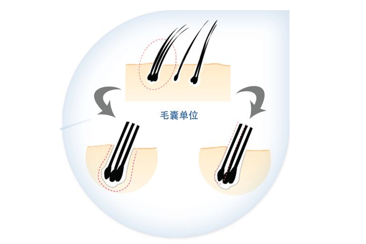 毛發種植