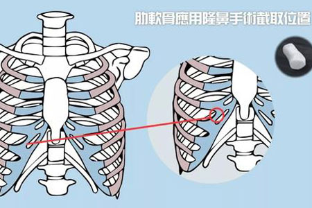 深圳隆鼻醫(yī)院做軟骨隆鼻多少錢(qián)