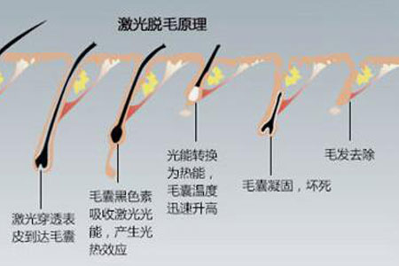 冰點脫毛的價格多少