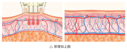 超光子+水光，“撐起”皮膚彈、潤、緊