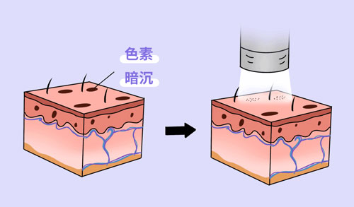 想要嫩膚，應該選擇做光電還是水光